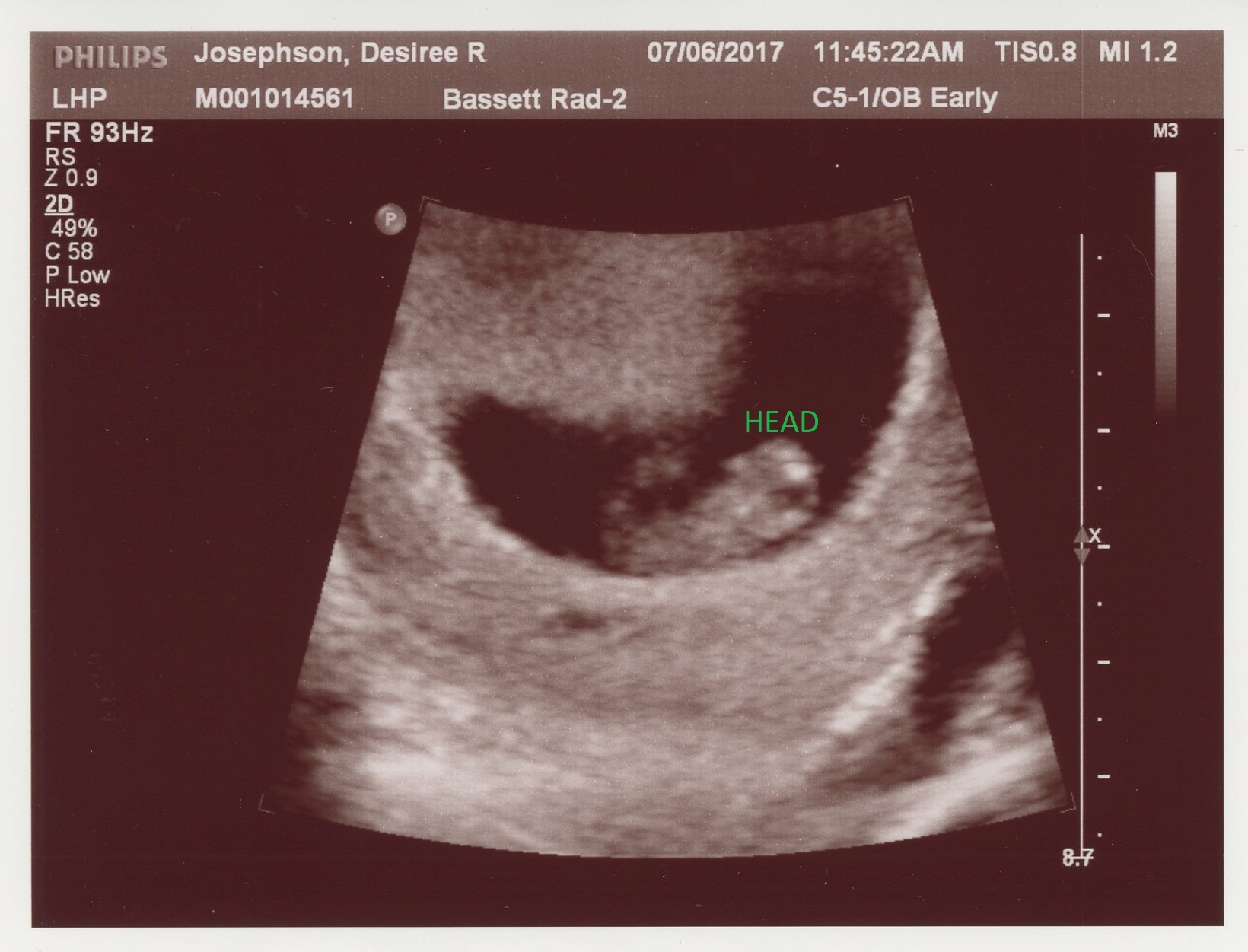 20170706 ultrasound-head